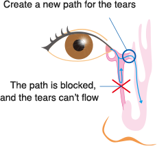 Epiphora (medicine) - Wikipedia